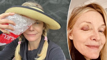 Michelle Pfeiffer gets a nasty black eye on pickleball court